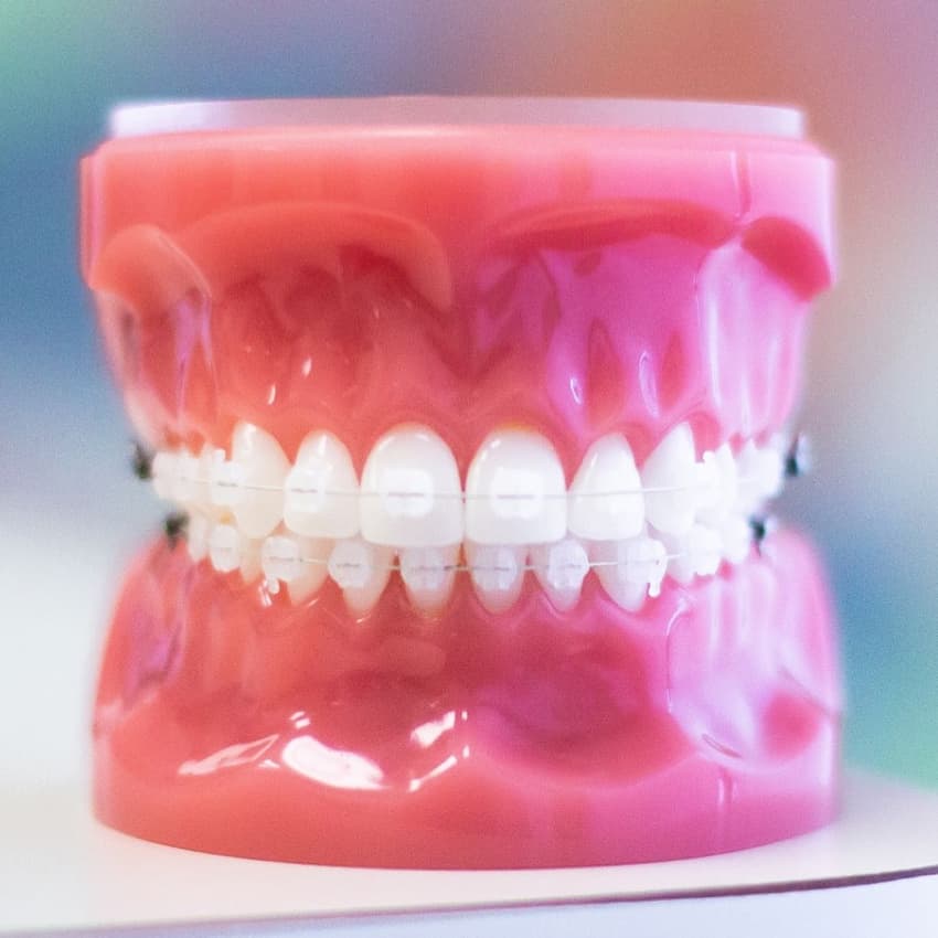 Clear Braces on Plastic Model