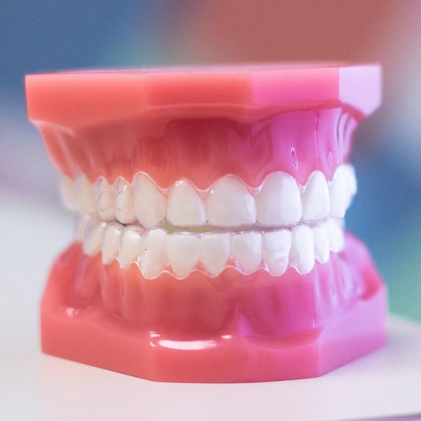 Invisalign Aligners on Plastic Model