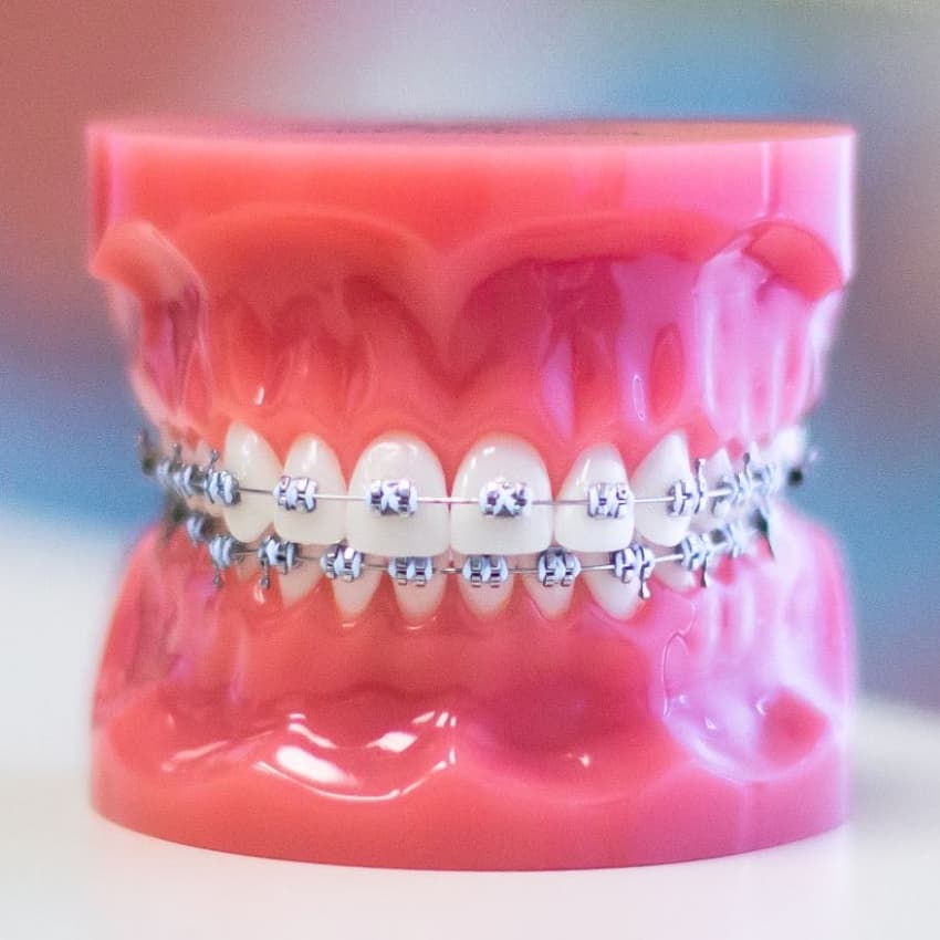 Metal Braces on Plastic Model